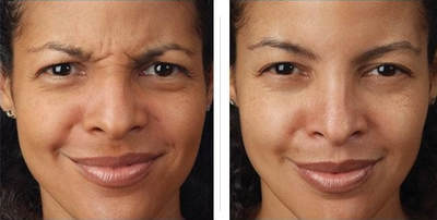 Botox Botox & Fillers No more wrinkles Boston and Woburn Medical Spa Before and After